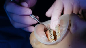 Conselho Federal de Odontologia emite alerta sobre morango do amor