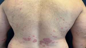 Estudo clínico pioneiro avalia novo tratamento para Psoríase em pacientes pediátricos em Salvador